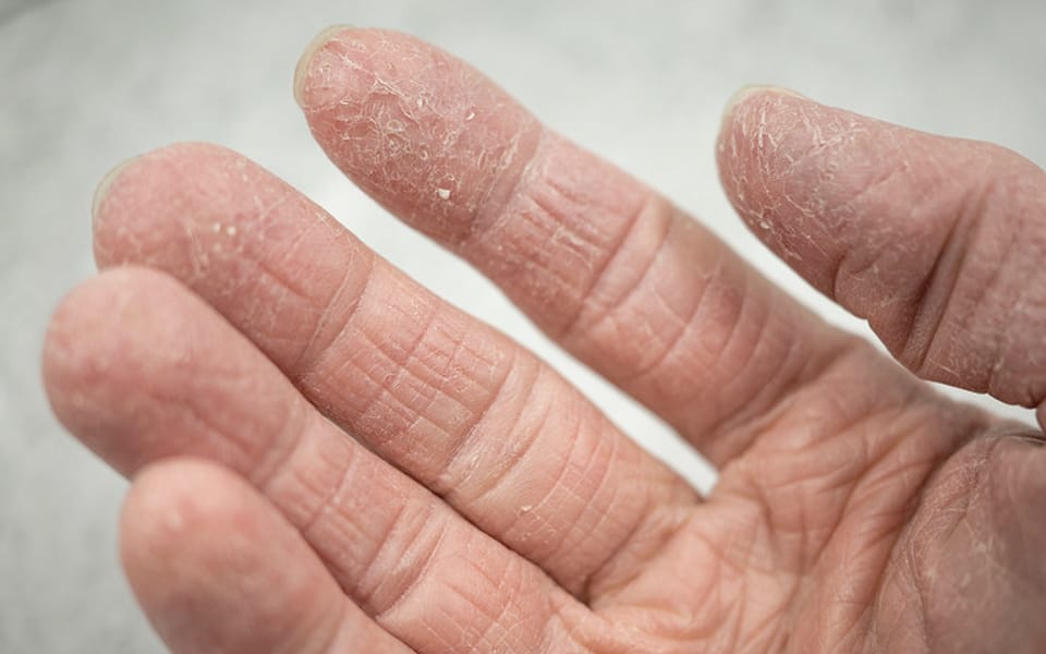 Dry, cracked skin on the fingers of a hand.